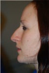 chirurgie du nez